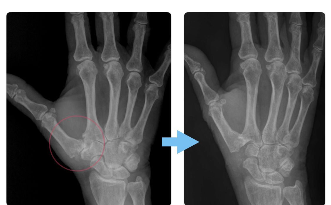 X-ray of a thumb after trapeziectomy
