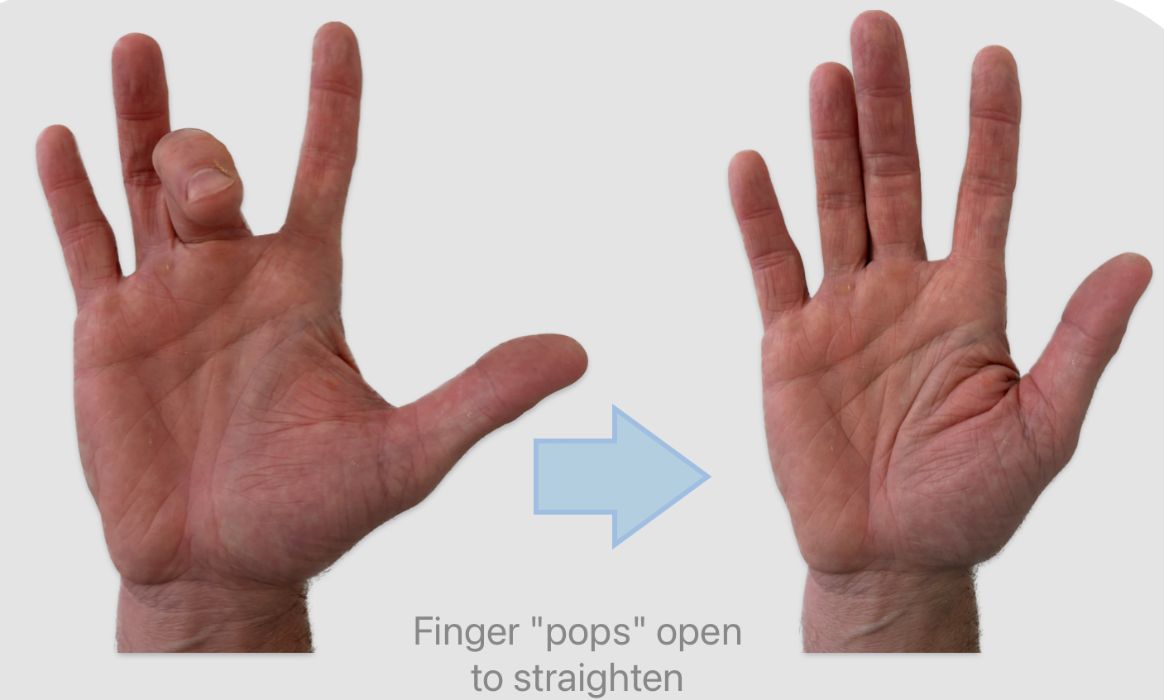 A finger locked in a bent position from trigger finger