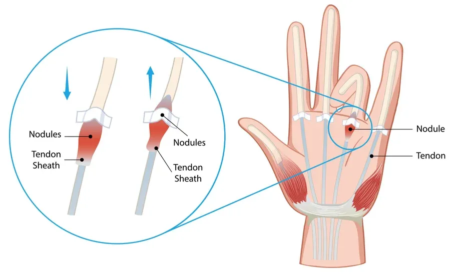 Diagram of trigger finger anatomy showing the tendon and pulley