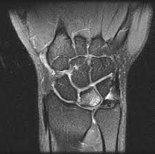 MRI scan of the wrist showing ulnar carpal impaction