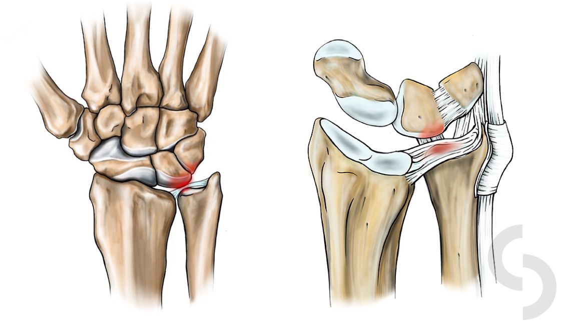 Diagram of ulnar carpal impaction, with a long ulna pressing on the wrist bones
