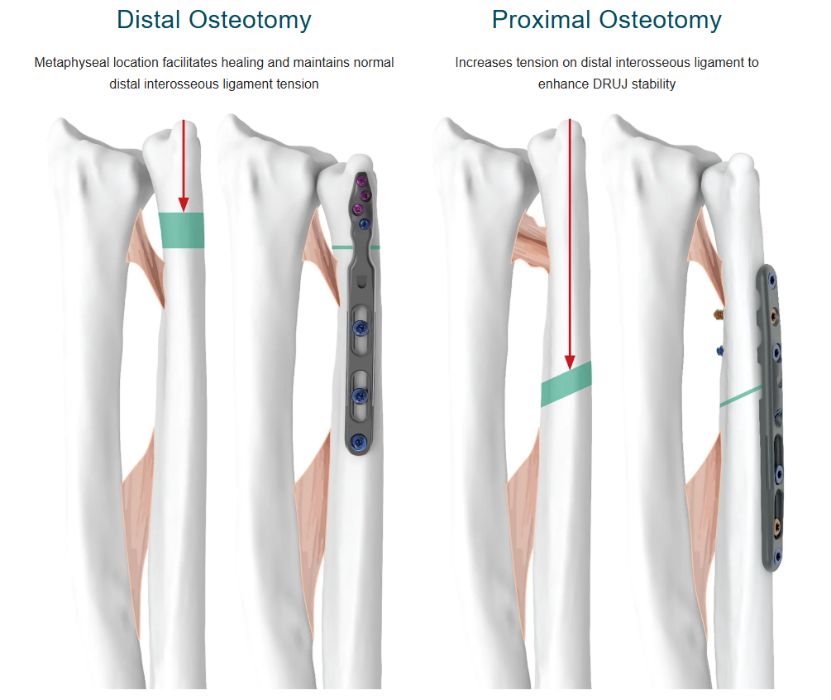 Ulnar shortening osteotomy of the forearm
