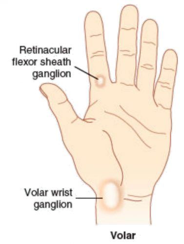 Ganglion on the palm side of the wrist