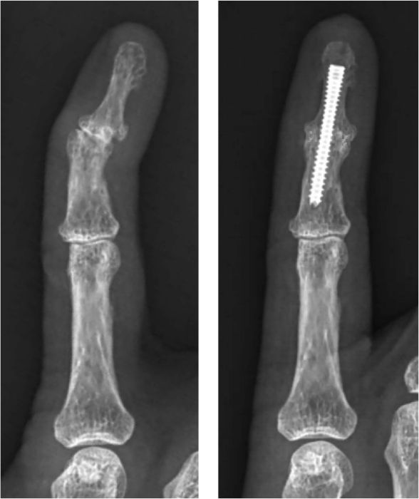 X-ray of a fused DIP joint