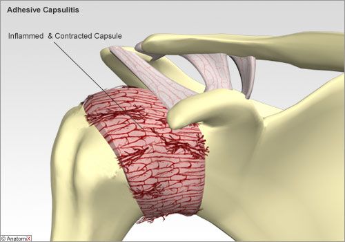 Illustration of frozen shoulder showing a thickened, tight joint capsule