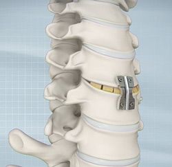 Anterior cervical discectomy and fusion