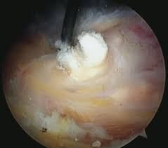 Arthroscopic view of a calcific deposit being removed surgically