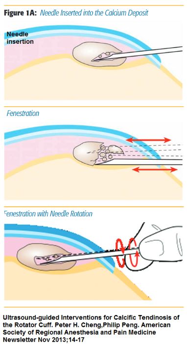 Calcific tendonitis needling (barbotage) under ultrasound guidance