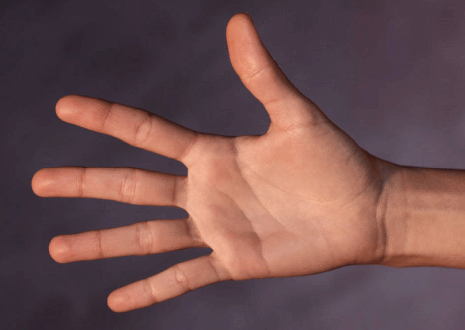 Illustration of carpal tunnel syndrome at the wrist
