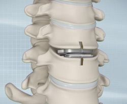 Cervical disc replacement