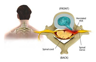 Disc bulge pressing on a nerve root in the neck