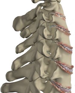 Cervical spondylosis
