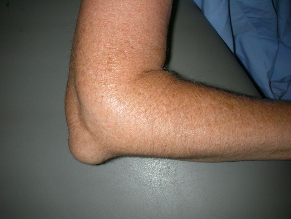 Swelling over the point of the elbow from olecranon bursitis