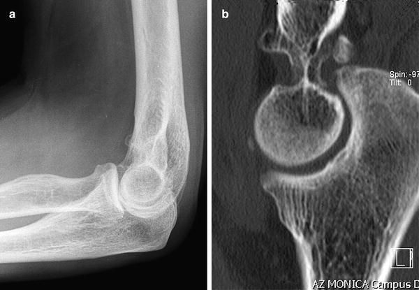 Elbow arthritis