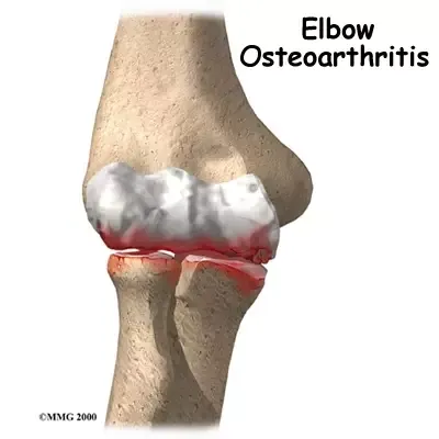 Illustration explaining what elbow arthritis is