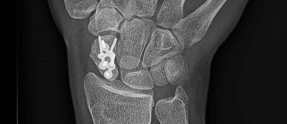 X-ray of a scaphoid plate fixing a wrist fracture