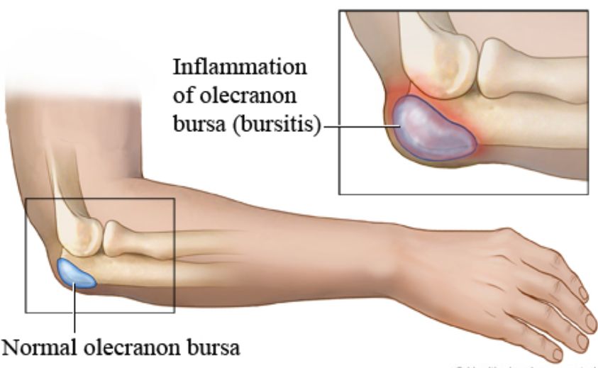 Diagram of the olecranon bursa at the back of the elbow
