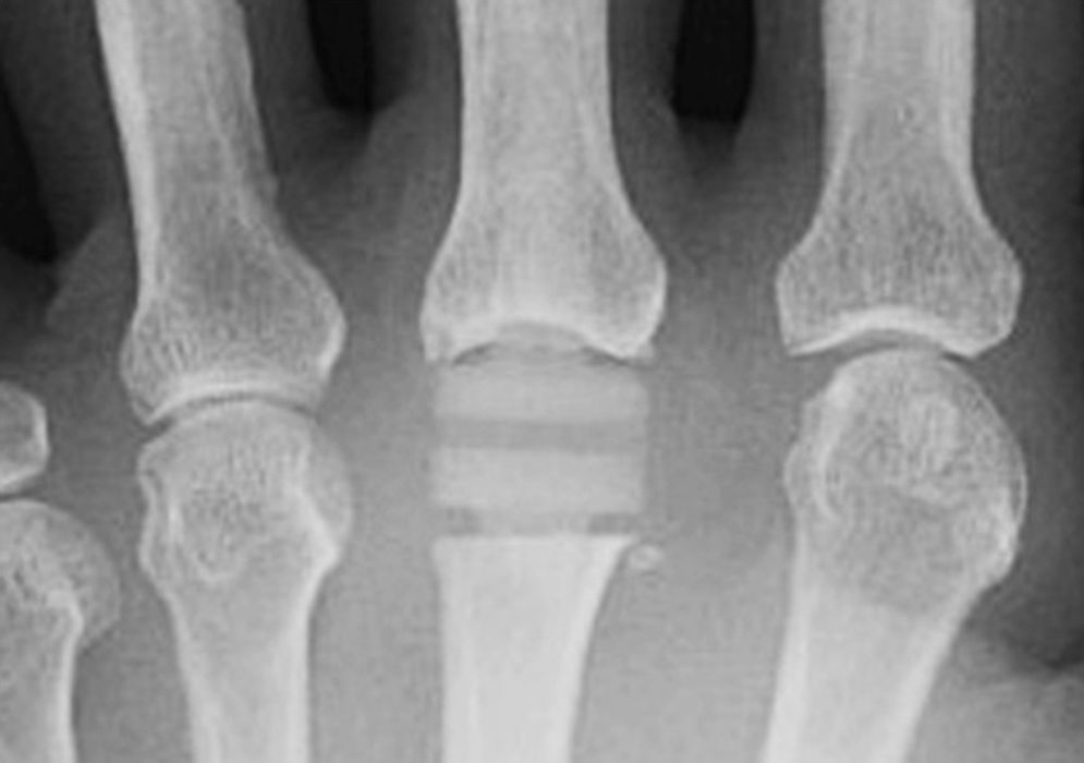 MCP knuckle joint replacement