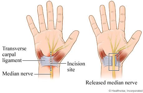 Carpal tunnel release surgery at the wrist