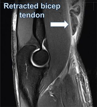 MRI scan showing a distal biceps tendon rupture