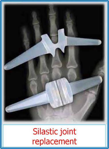 PIP joint replacement