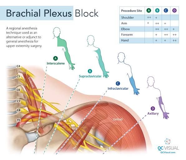Nerve blocks used to numb the arm for upper limb surgery