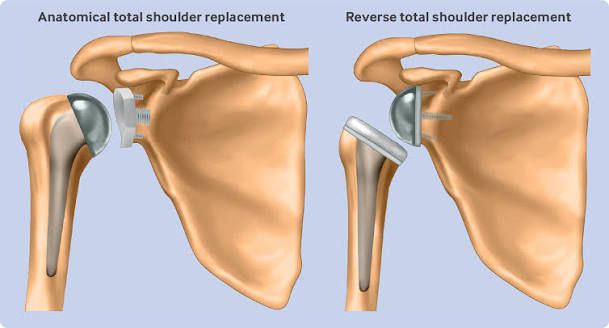 Anatomical total shoulder replacement compared with a reverse total shoulder replacement