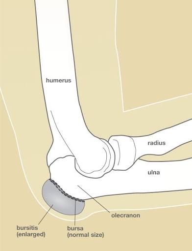 Illustration of a swollen olecranon bursa