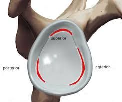 Diagram of labral tears around the shoulder socket