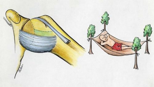 Diagram of the shoulder ligaments forming a hammock beneath the ball of the joint