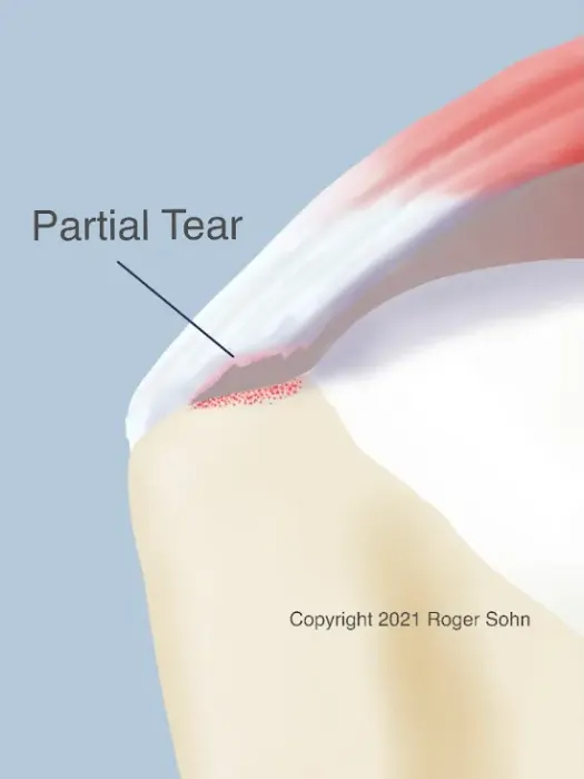 Illustration of a partial articular supraspinatus tendon avulsion (PASTA) tear