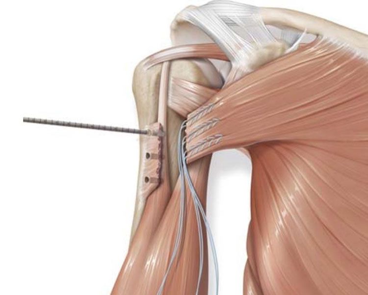 Pectoralis major tendon repair during surgery