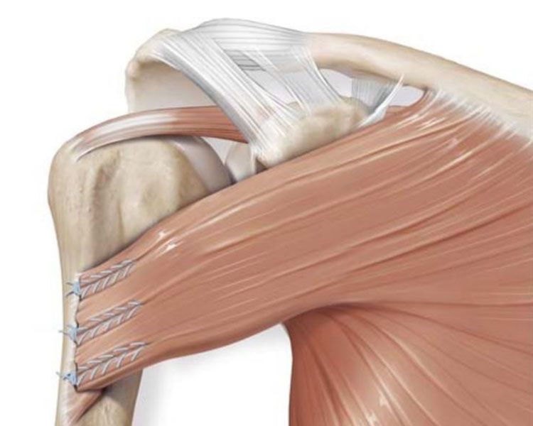 Pectoralis major tendon repair during surgery, second view