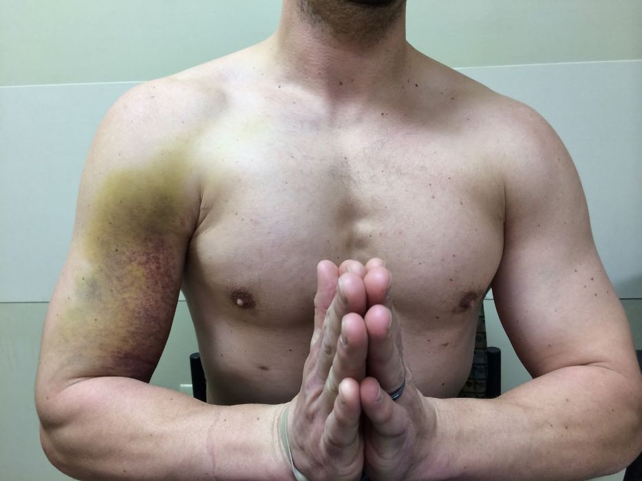 Bruising across the chest and upper arm after a pectoralis major tear