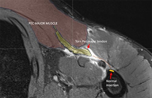 MRI scan showing a pectoralis major tendon tear
