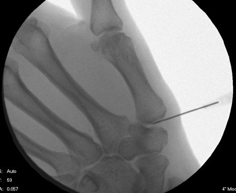 Image-guided injection into the thumb base (CMC) joint
