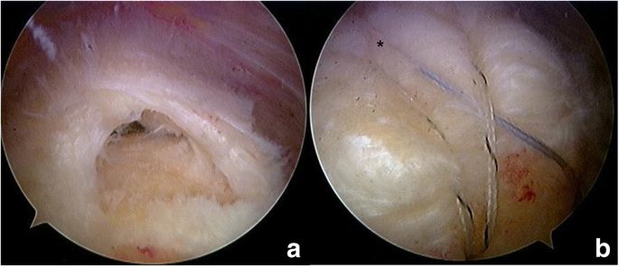 Arthroscopic rotator cuff repair, before and after