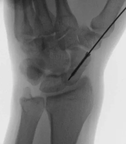 Scaphoid screw and guidewire