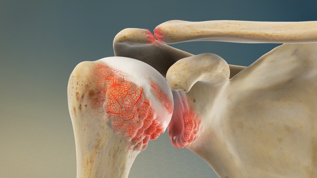 Illustration of shoulder arthritis