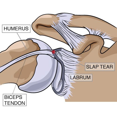 Illustration of a labral tear and a SLAP tear in the shoulder socket